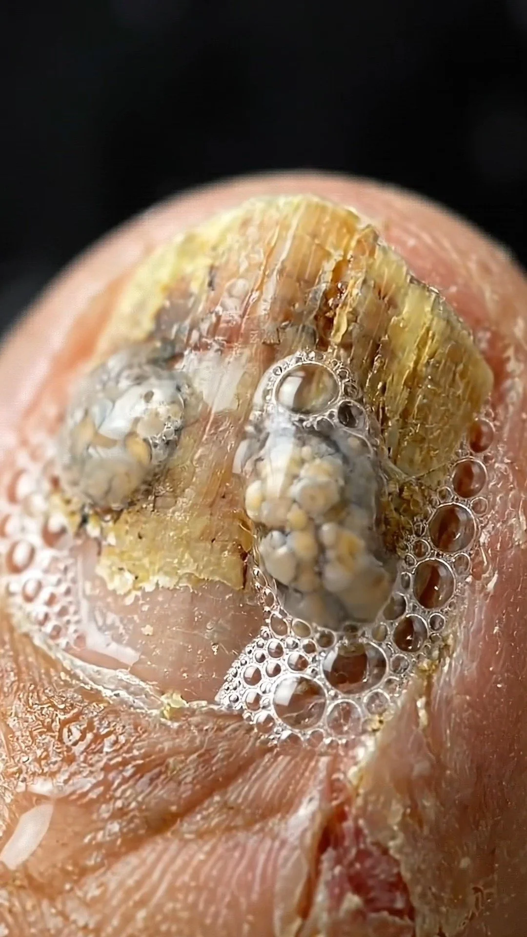 Preventing fungal infection from worsening with effective treatment strategies