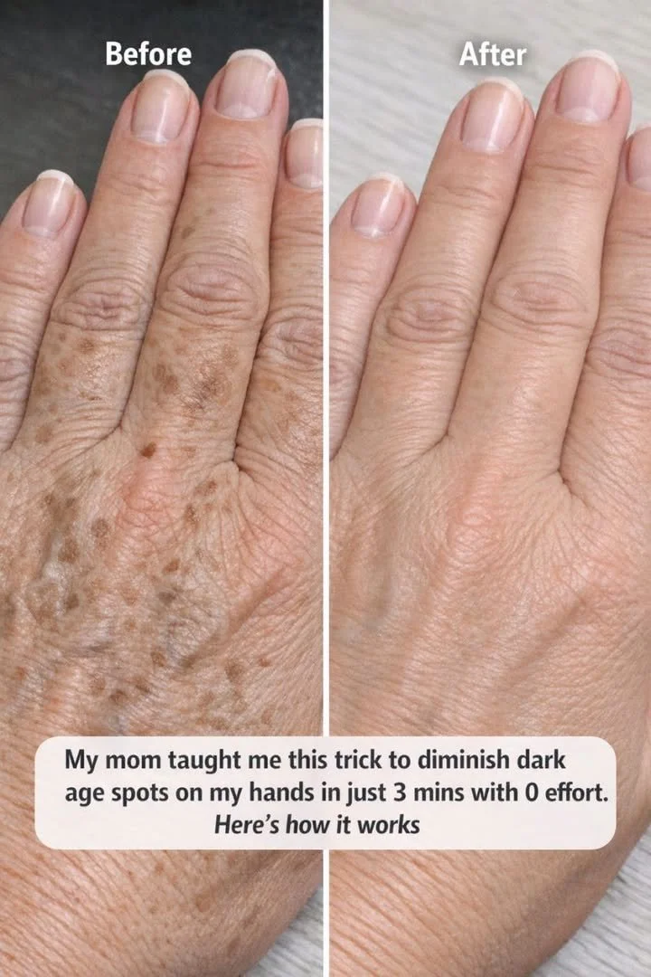 Before and after treatment for dark age spots on hands