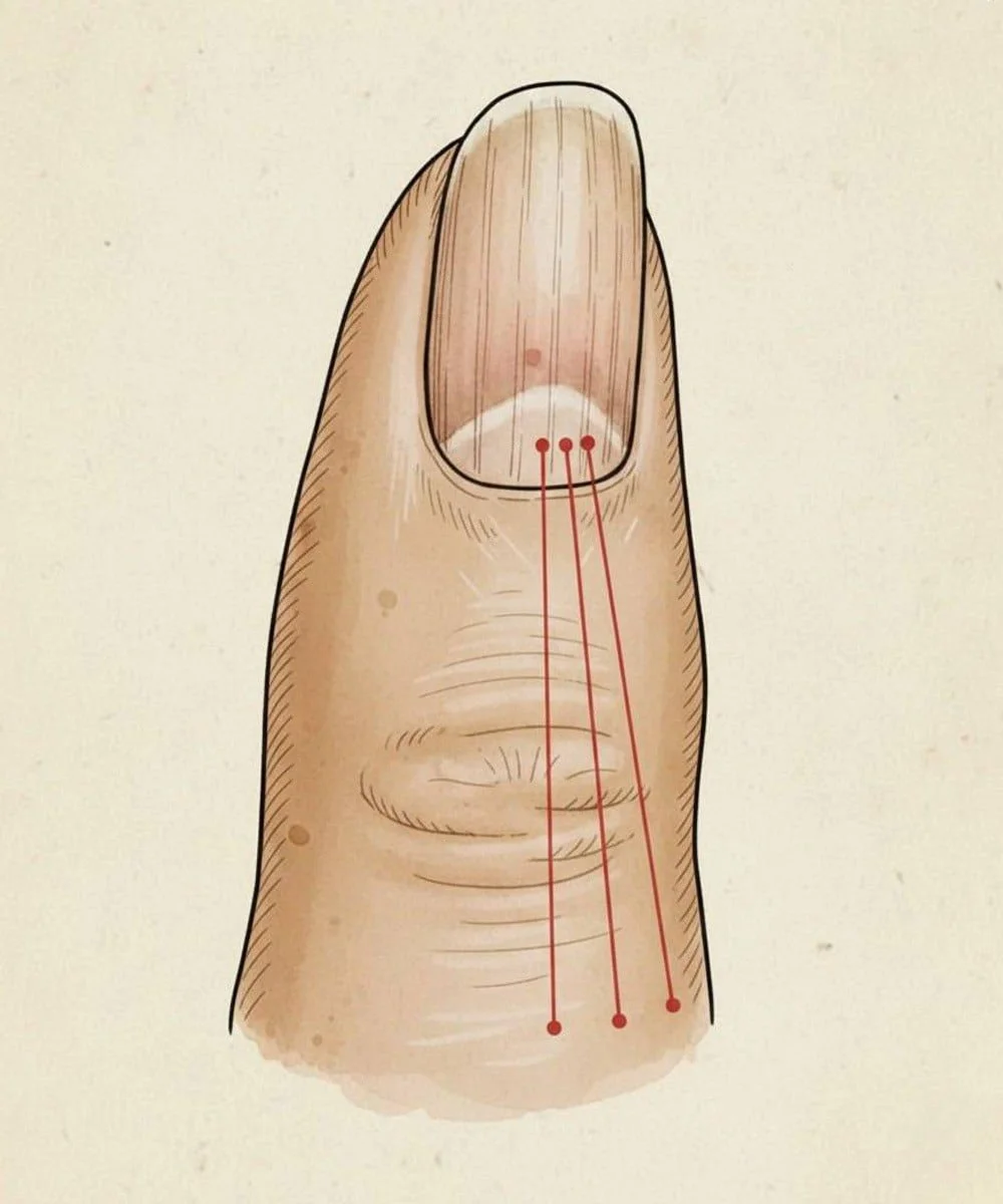 Close-up of nails showing various changes and lines, indicating health conditions.